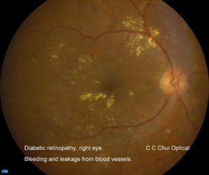 Diabetic retinopathy OD-2