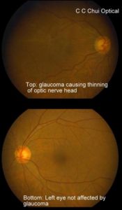 Glaucoma 2