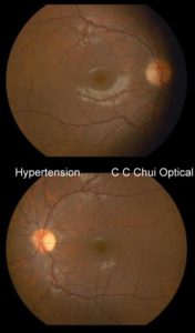 Hypertension (2)a