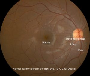 Normal fundus 2a RE