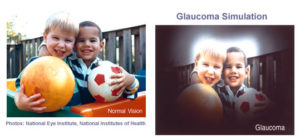 glaucoma vision